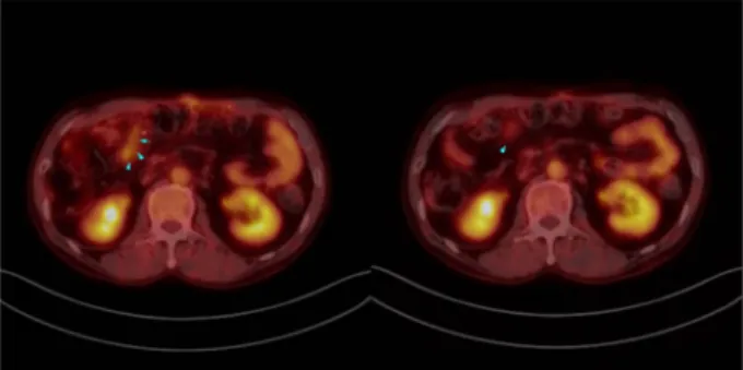 그림 3. SPARQL 쿼리 예의 PET-CT 사진. (SPARQL 쿼리에서 검색한대로 화살표로 표시된 좌측 사진의 병변의 FDG 집적도가 다 음 번 사진에서 감소되어 보인다).
