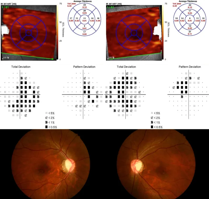 Figure 1. Representative figure of a 40-year-old female with visual acuity of 0.30 logarithm of minimal angle of resolution  (logMAR) in the right eye and 0.30 logMAR in the left eye, showing a severe decrease in the retinal ganglion cell layer thickness