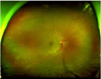 Figure 2. Ultra-widefield fundus image and optical coherent  tomography at the sixteen day after (A) retinal detachment  with giant retinal tear were noticed in the fundus examination