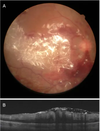 Figure 3. Fundus photo and optical coherent tomography at  the next day of the surgery (A) multiple crystal deposit with  multiple retinal hemorrhages was noticed on the fundus  examination