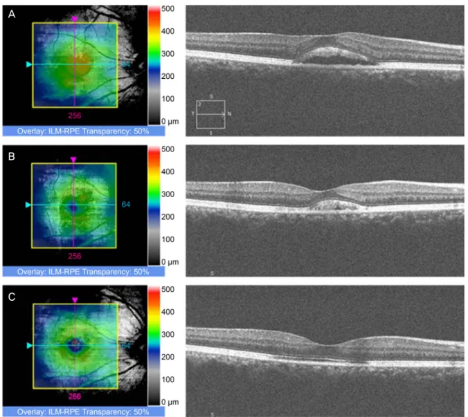 Figure 1. Changes of macular thickness map and optical coherence tomography scan of a patient with central serous chorioretinop- chorioretinop-athy at baseline (A), at 1 month (B) and 3 months (C)