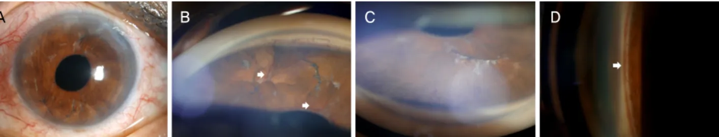 Figure 1. Initial anterior segment photographs of the left eye. (A) Slit-lamp examination showing diffuse iris neovascularization