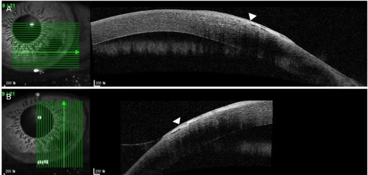 Figure 2. Anterior segment optical coherence tomography of the left cornea. Hyper-reflective signals pointed by arrowheads involv- involv-ing both Bowman’s layer and superficial cornea (A, B).