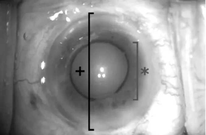 Figure 1. Calculation of the intraoperative pupil size. The pu- pu-pil size was calculated with the ratio of the horizontal length of  the pupil (*) and the length between the limbus of cornea (†)  compared with the preoperative horizontal diameter of the 