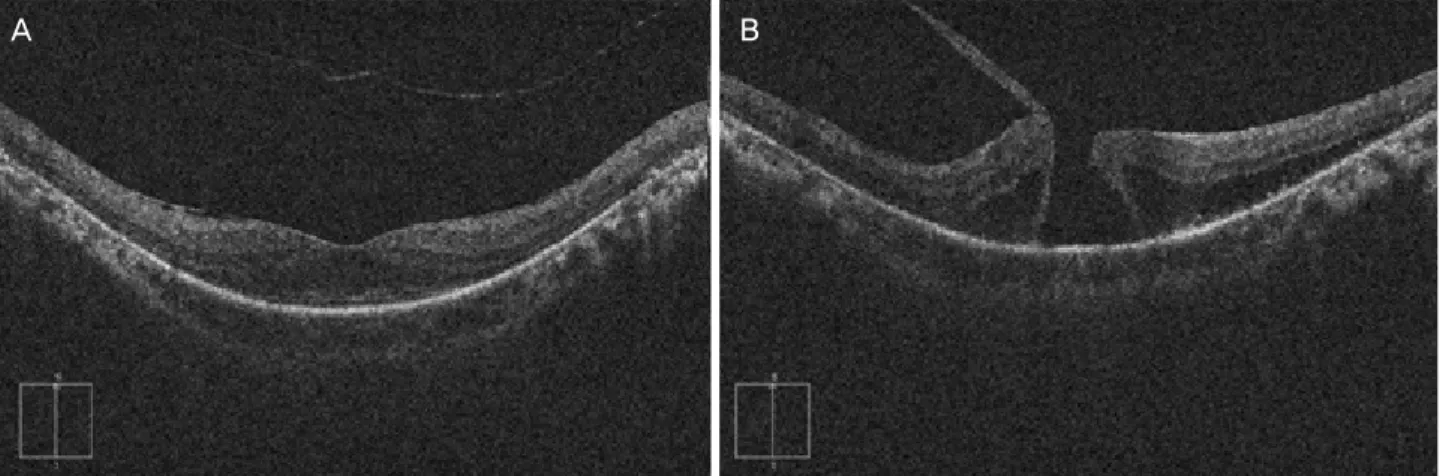 Figure 2. The preoperative optical coherence tomography images of the right (A) and left (B) eyes of the study patient are presented