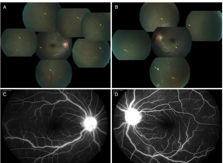 Figure 1. Color fundus photo of the first case. Right (A), left (B), both fundus photos showed multiple whitish lesions (arrows) and  mild optic disc swelling