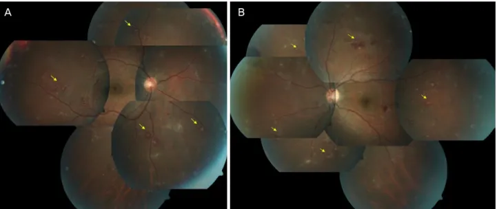 Figure 3. Color fundus photo of the second case. Right (A), left (B), both fundus photos showed multiple infiltrations with hemor- hemor-rhage (arrows) and optic disc swelling