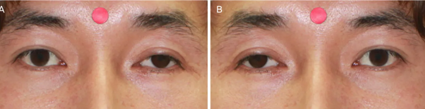 Figure 1. Laterality of a patient with a left ocular prosthesis. (A) Original photograph