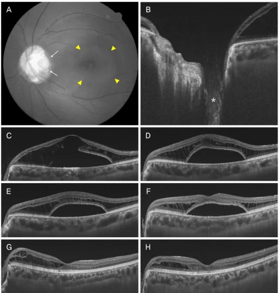 Figure 1. Composite of the representative images from patient 1. (A) fundus photograph showed a round optic pit (white arrows) and  serous retinal detachment (yellow arrowheads) at the initial visit