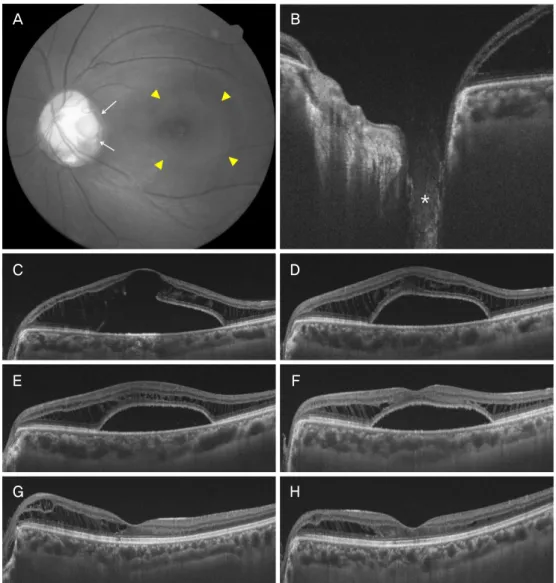 Figure 1. Composite of the representative images from patient 1. (A) fundus photograph showed a round optic pit (white arrows) and  serous retinal detachment (yellow arrowheads) at the initial visit