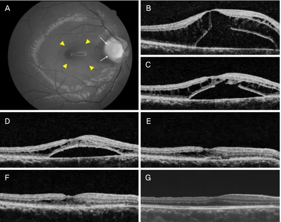 Figure 2. Composite of the representative images from patient 2. (A, B) Fundus photograph and optical coherence tomographic  (OCT) images showed an optic pit (white arrows), retinoschisis and serous retinal detachment (yellow arrowheads) at the baseline