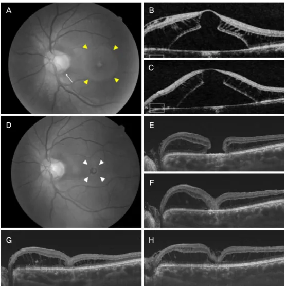 Figure 3. Composite of the representative images from patient 5. (A, B) Fundus photograph and optical coherence tomography  (OCT) images showed the optic pit (white arrows), retinoschisis and and serous retinal detachment (yellow arrowheads) at the initial