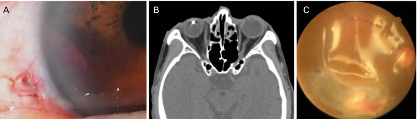 Figure 2. Case 2. (A) A preoperative photo of anterior segment shows 3 mm sized laceration in sclera which is 1 mm apart from  limbus