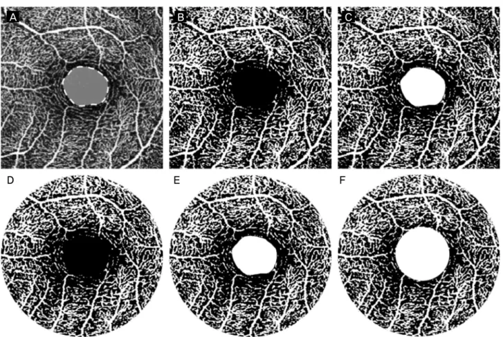 Figure 1. Optical coherence tomography angiography analysis areas. (A) Manual drawing of the foveal avascular zone (FAZ) area  (gray) and boundary (white dot line)