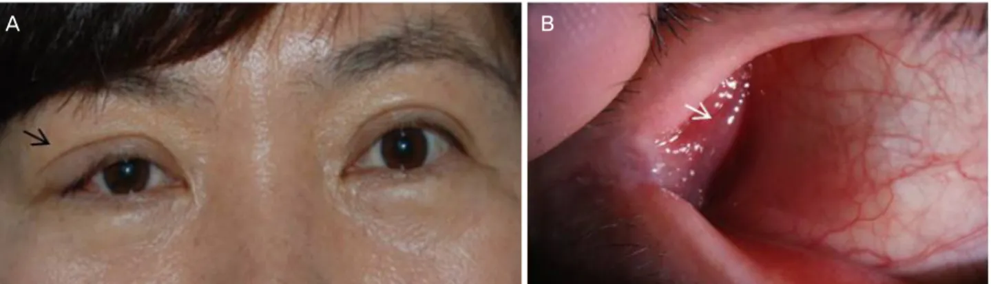 Figure 1. Clinical photograph. (A) Moderate firm, palpable mass with eyelid swelling (black arrow) is seen at right upper eyelid