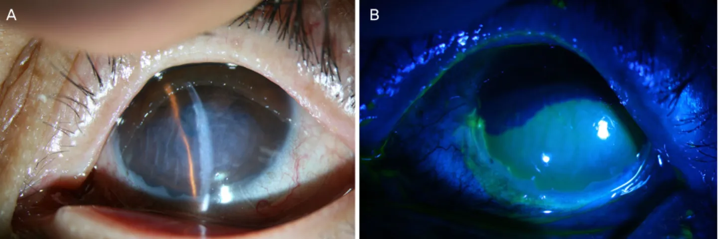 Figure 2. Anterior segment optical coherence tomography im- im-ages of the cornea in the left eye with chemical injury at the  in-itial presentation