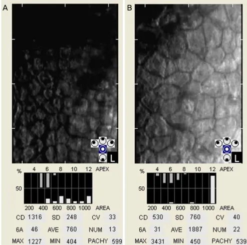 Figure 3. Qualitative and quantitative  analysis of central corneal endothelial  cell in the left eye with chemical injury.