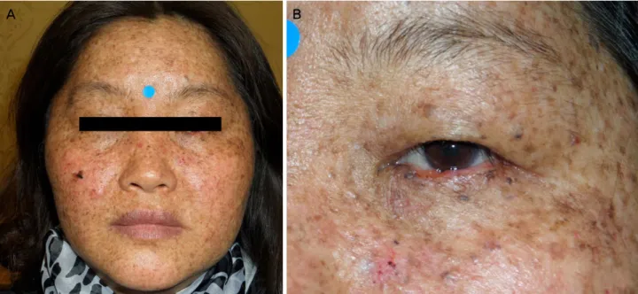 Figure 1. Facial photos of the patient. (A) Multiple freckle-like hyperpigmented macules and cancer-suspicious skin lesions were  found