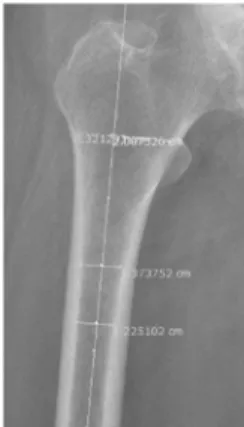 그림  1. x-ray 를 이용한 설계변수 측정 Fig. 1. Design parameter extraction from x-ray image이며 고관절 질환에 대한 통증을 완화시키고 운동범위를 회복시키