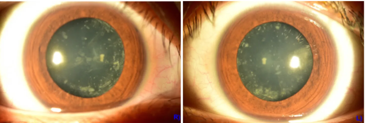 Figure 2. Anterior segment photography at the first visit. It shows cortical opacity and subcapsular cataract on her both eyes.