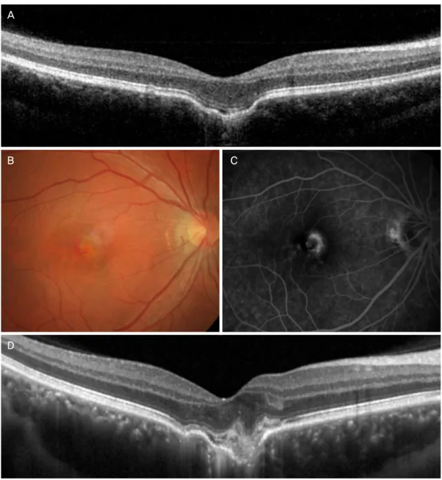 Figure 2. Clinical course of a focal choroidal excavation found in 29-year-old patient
