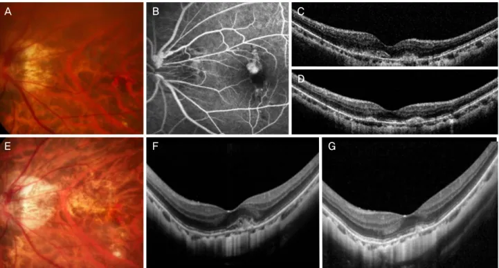 Figure 1. Clinical course of a 52 year-old patient who was diagnosed with myopic choroidal neovascularization (CNV) in the left eye