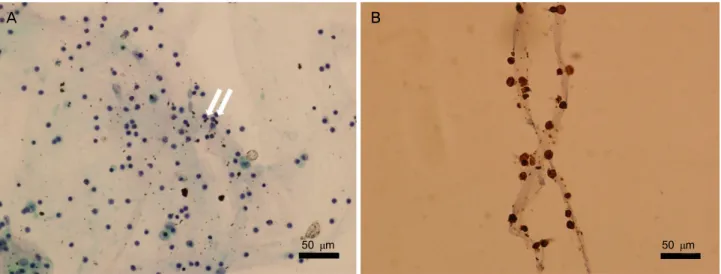 Figure 2. Microscopic features of vitreous tap. Hematoxylin and eosin stain reveals scattered small T-lymphocytes (arrows) with  macrophages (A, ×400)