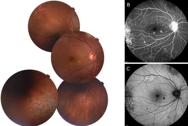 Figure 4. Fundus findings at 10 months after multiple intravitreal methotrexate injections