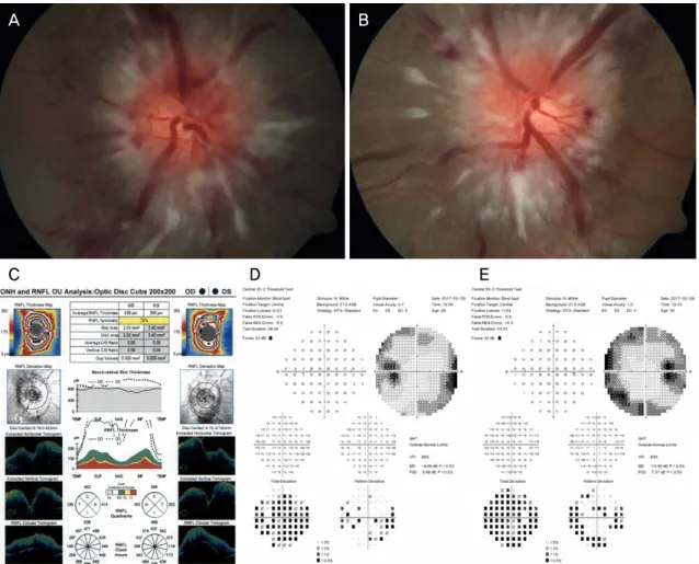 Figure 1. Case 1. The fundus showed the diffuse optic disc swelling and hemorrhage in both eye at the first visit (A) OD, (B) OS