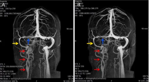 Figure 3. Case 2. The fundus showed the diffuse optic disc swelling and hemorrhage in both eye at the first visit (A) OD, (B) OS