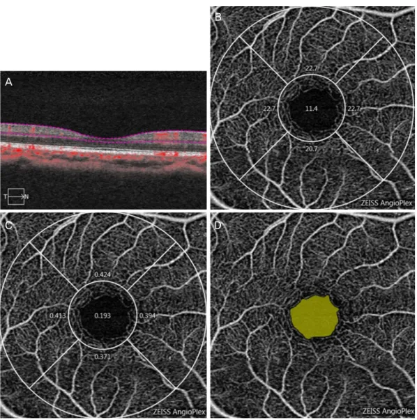 Figure 1. 3 × 3 mm optical coherence tomography angiography image centered on the fovea in normal subject