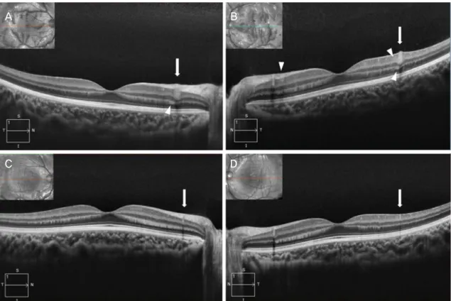 Figure 2. Spectral-domain optical coherence tomography (SD-OCT) sections over involved vessels