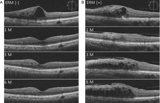 Figure 1. Representative optical coherence tomography images in patients with branch retinal vein occlusion associated with macular  edema and treated with intravitreal dexamethasone implant (Ozurdex ® , Allergan, Irvine, CA, USA)