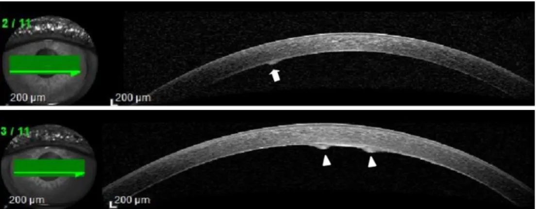 Figure 2. Anterior segment optical coherence tomography of both eyes. The lesions were protruded from the endothelial layer