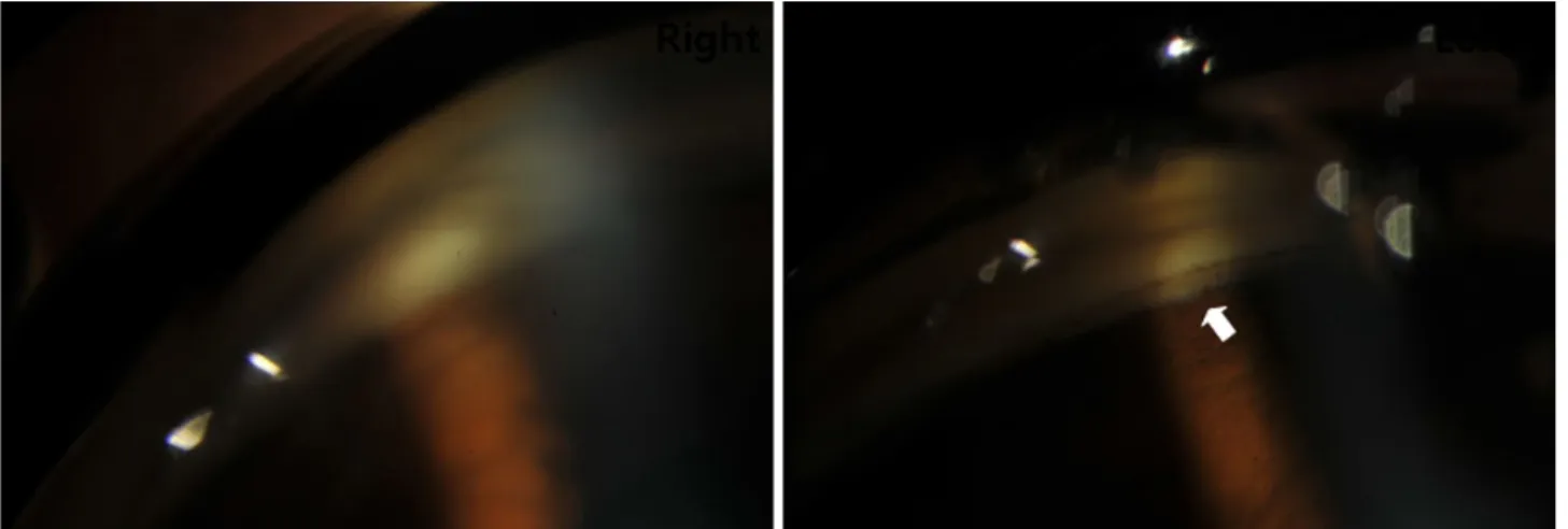 Figure 3. Specular microscopy of both eyes at initial examination. (A) In the right eye, the endothelial cells became large and the  density of the cells decreased to 668 cells/mm 2 