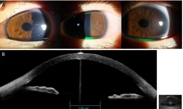 Figure 2. The images were taken on the next day after injury. On slit lamp examination, corneal edema was significantly improved  and small corneal abrasion was visualized on temporal side of it (A)