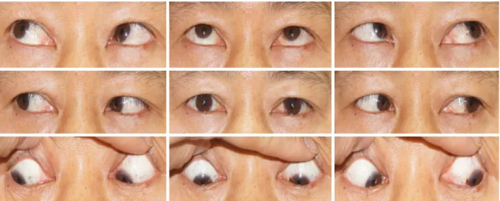 Figure 3. Nine gaze photos at postoperative 4 months. Ocular eye movement and dilated pupil in the left eye were completely  recovered