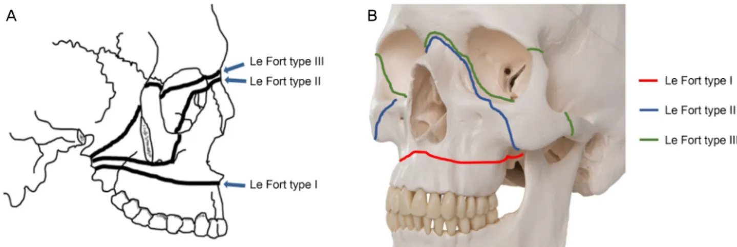 Figure 2. A coronal section of case patient's facial computed  tomography. The image shows fractured lateral and medial  pterygoid plates of the left side (white arrows).