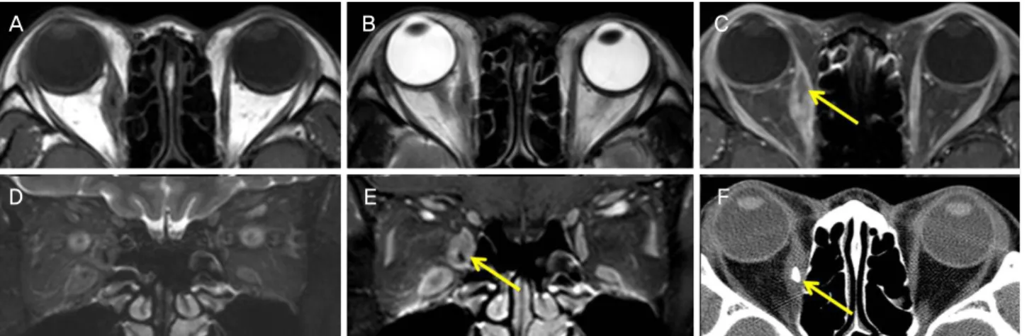 Figure 3. Orbit magnetic resonance imaging (A-E) and computed tomography (F). The T1-weighted (A) and the T2-weighted (B)  axial images showed iso-intense enlarged medial rectus muscle on the right eye