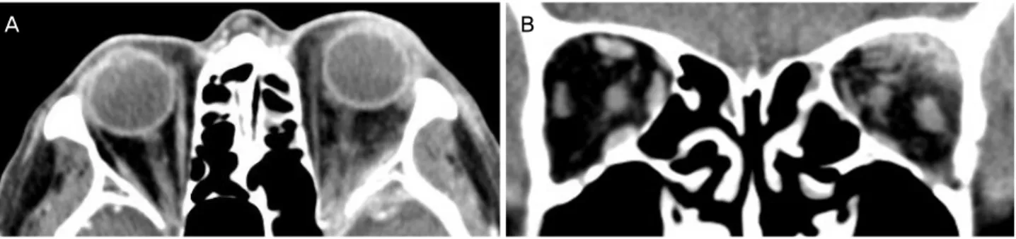 Figure 2. Coronal and axial orbit computed tomography scans (axial [A] and coronal [B] views) showing irregular mass like soft tis- tis-sue density of anterio temporal pole and superolateral orbital wall with well contrast enhancement and underlying bone e