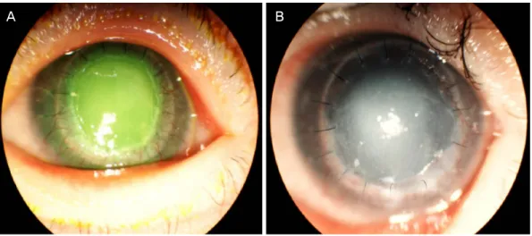 Figure 3. Anterior segment photograph of left eye of the patient with Keratitis-Ichthyosis-Deafness syndrome, 1 month after pene- pene-trating keratoplasty