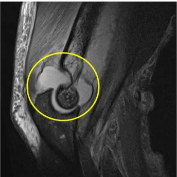 Figure 2. Magnetic resonance imaging finding. Enhanced con- con-trast within the elbow joint consistent with elbow joint abcess  (yellow circle)