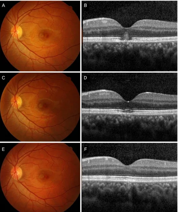 Figure 1. (Patient 1) Fundus photograph (A) and SD-OCT image obtained (B) at the first ophthalmic examination showing a yellow- yellow-ish retinal scar in the fovea and IS/OS junction disruption, hyperreflective band in the outer nuclear layer and RPE inju