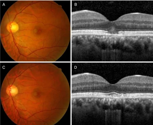 Figure 3. (Patient 3) Fundus photograph (A) and SD-OCT image (B) at the first ophthalmic examination showing yellowish retinal  scar in the fovea and IS/OS junction disruption, hyperreflective band in the outer nuclear layer and RPE injury in the left eye
