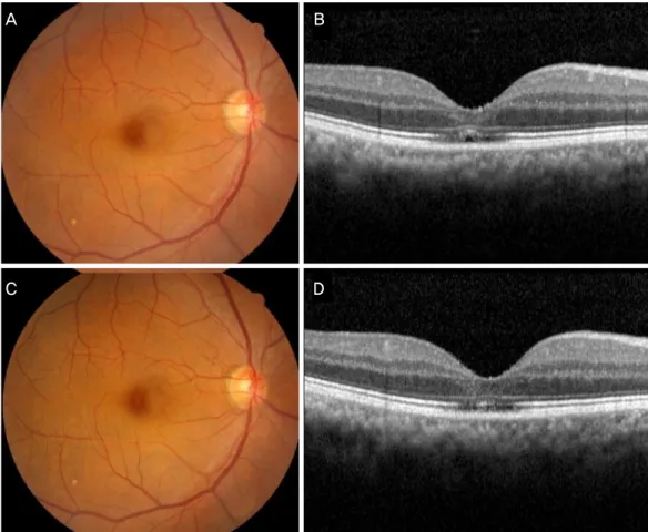Figure 4. (Patient 4) Fundus photograph (A) and SD-OCT image (B) at the first ophthalmic examination showing yellowish retinal  scar in the fovea and IS/OS junction disruption, RPE injury and hyporeflextive cystic lesion in the cone outer segment tips  (in