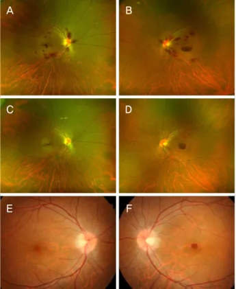 Figure 2. Spectral domain-optical coherence tomography  (SD-OCT) images at the initial presentation (A, B), at 1 month  follow-up visit (C, D) and at 3 months follow-up visit (E, F)