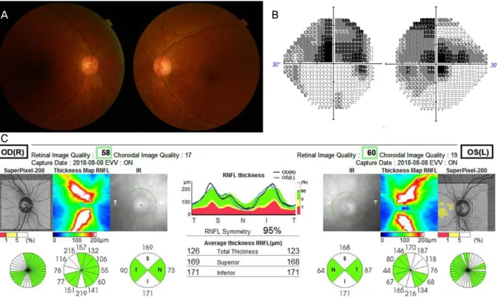 Figure 1. Initial FP, VF, and OCT findings. (A) FP shows slightly hyperemic disc on both eyes
