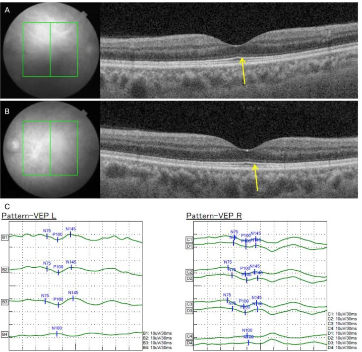 Figure 2. Initial macular OCT findings and initial VEP test. Arrows (A, B) show normal ellipsoid zone on both eyes
