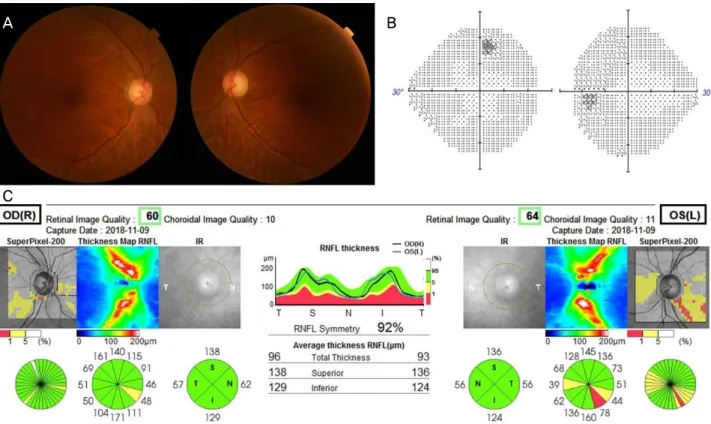 Figure 3. Follow up of FP, VF, and OCT. Three months later after treatment, (A) FP and (B) VF show normalized fundus and visual  field on both eyes