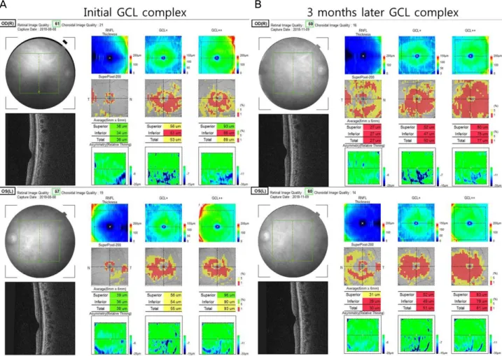 Figure 4. Compare with Initial GCL complex and 3 months later GCL complex. Initial (A) and 3 months later after treatment, GCL  OCT (B)